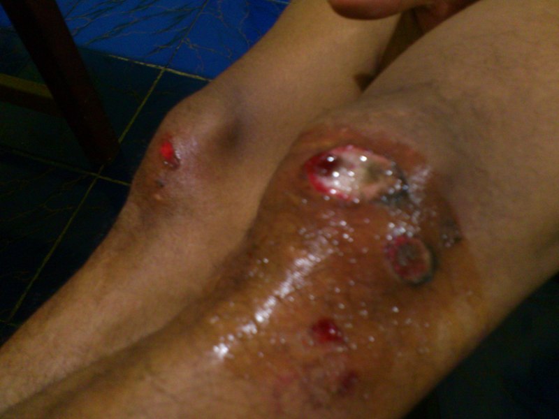 5.Ensu’s scars on his knees after washing with alcohol.JPG